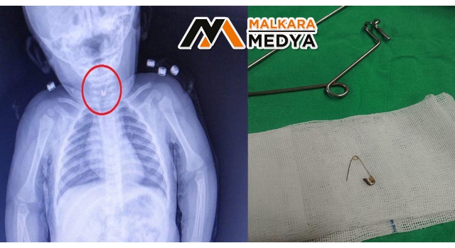 7 aylık bebeğin yemek borusundan çengelli iğne çıktı