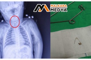 7 aylık bebeğin yemek borusundan çengelli iğne çıktı